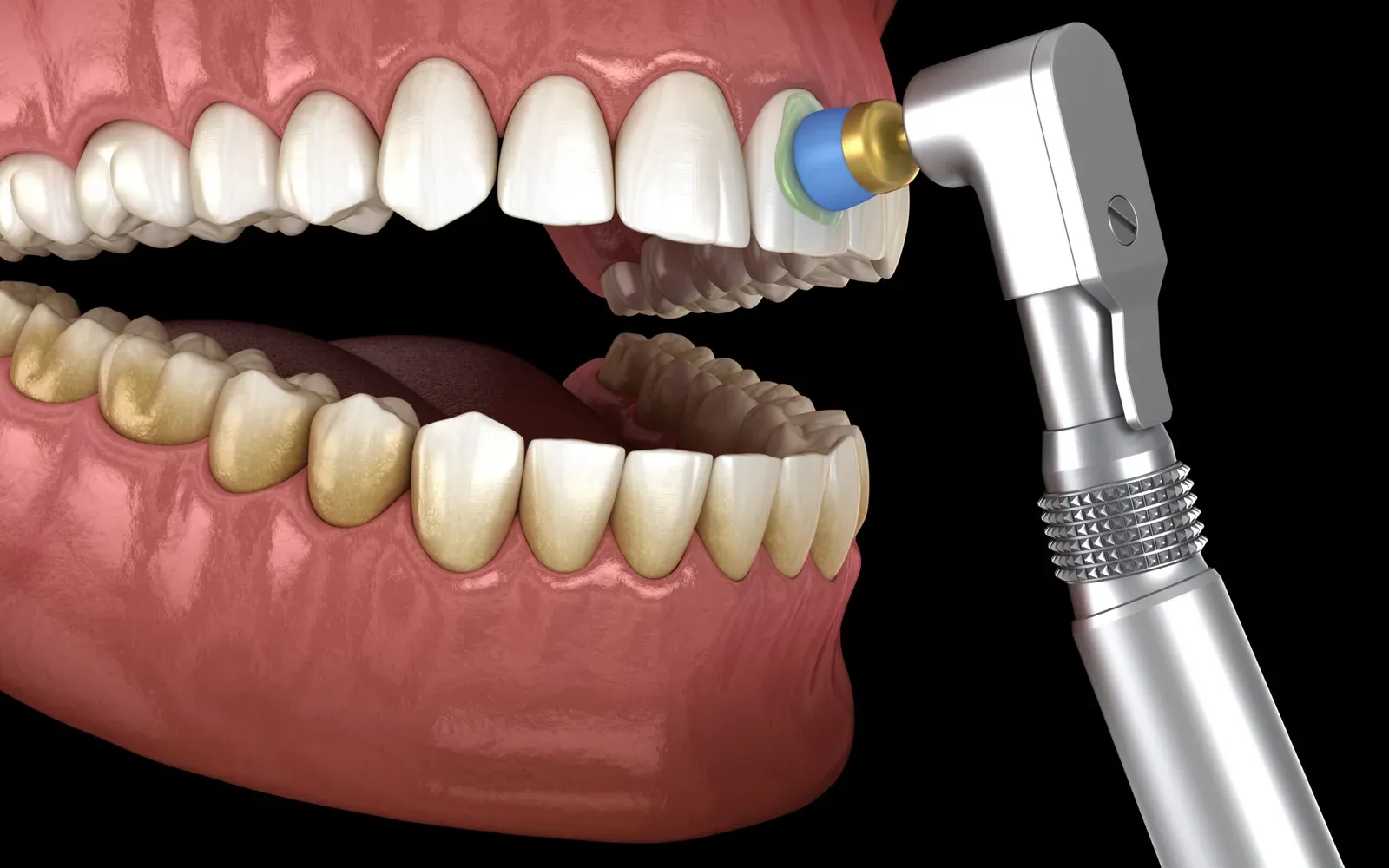 Dental Cleanings at Southeastern Dental Care in Lakeville, MA