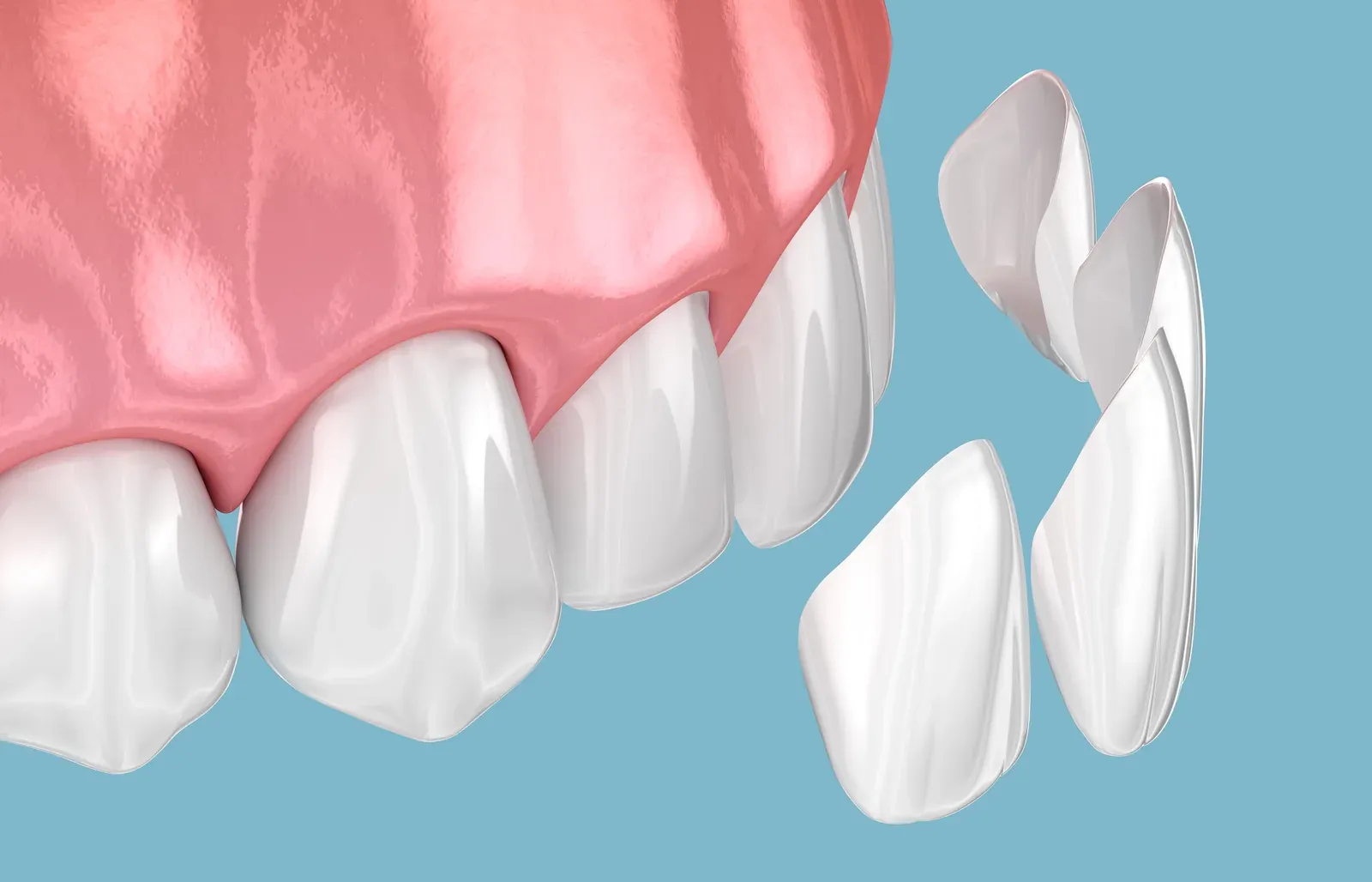 Veneers at Southeastern Dental Care in Lakeville, MA