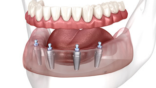 digital illustration of implant dentures  