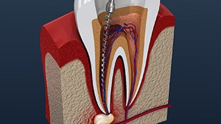 A 3-D cross-section image of a tooth undergoing a root canal